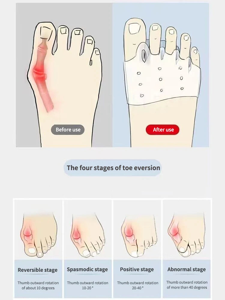 Silicone Toe Separator, Toe Spacer, Toe Stretcher, Thumb Eversion Correction Device, Forefoot Pad Protector